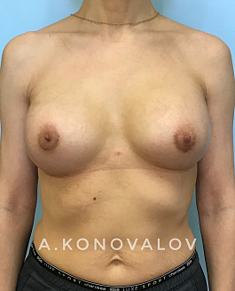 Пациент 3 "Увеличение груди" - фото 2