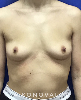 Пациент 1 "Увеличение груди" - фото 1