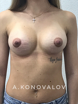 Пациент 10 "Увеличение груди" - фото 2