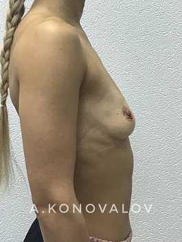 Пациент 6 "Увеличение груди" - фото 1