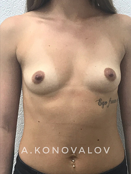 Пациент 10 "Увеличение груди" - фото 1