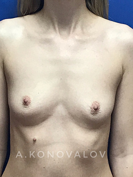 Пациент 4 "Увеличение груди" - фото 1